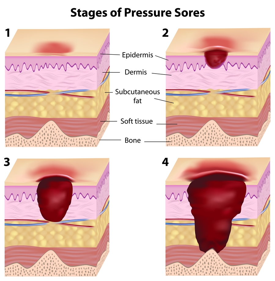 Elderly Bed Sores, Stages 1- 4 Of Pressure Sores