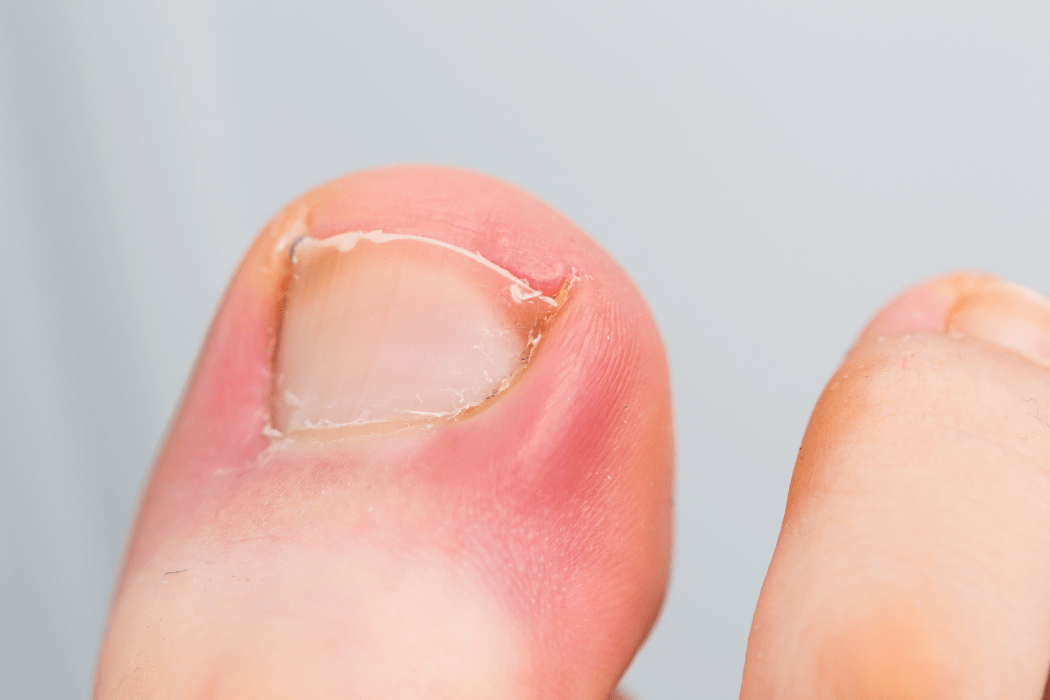 Ingrown Toenail Self Care Tips