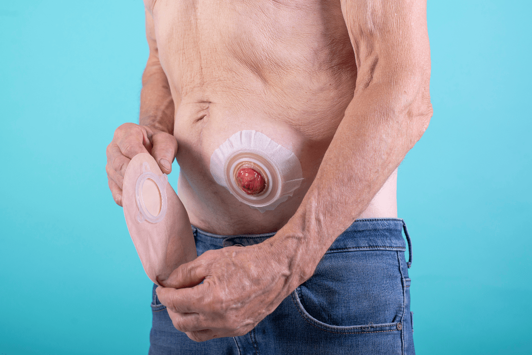 Stoma Care Tips