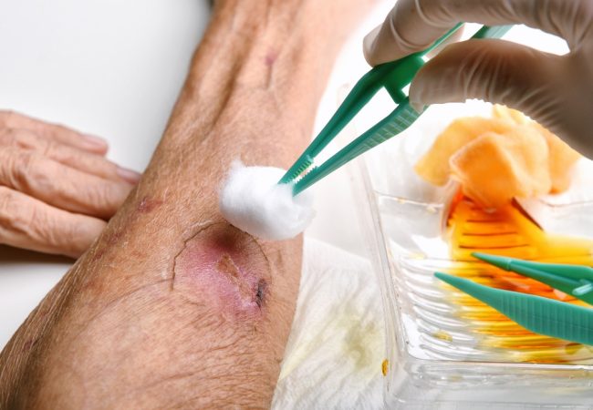 elderly bed sores, helpful tips